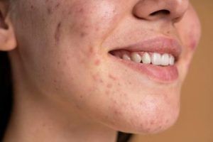 May aid in the healing of acne