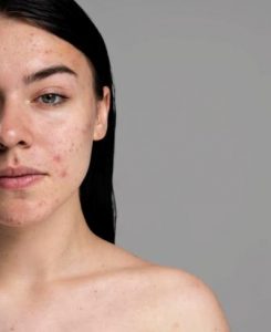 Acne-Prone Skin