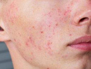 red spots on face
