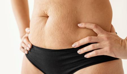 Reducing Stretch Marks