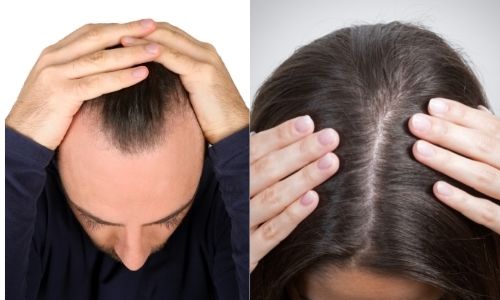 Types of hairline in men and women