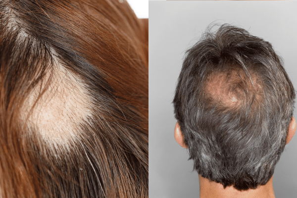What are the types of bald spots