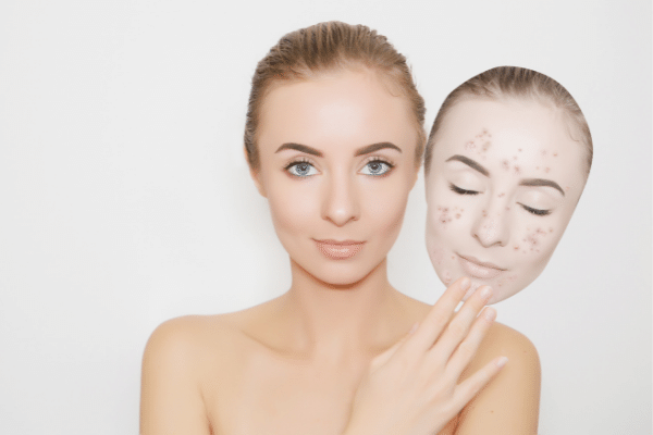 These are some natural remedies to include in your diet to remove pimples