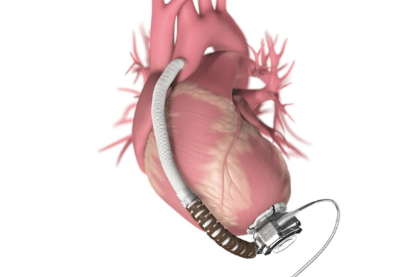 Ventricular assist devices