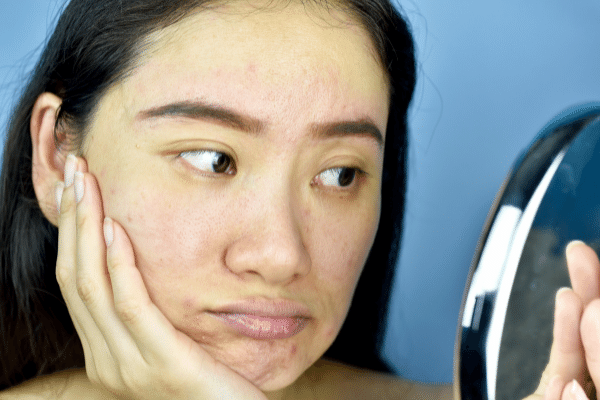 What are the reasons behind dull skin