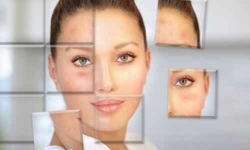 Tips for Acne-Prone Skin